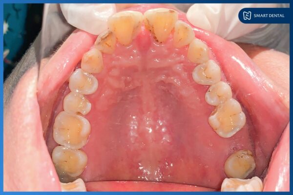 Cấy ghép Implant Hiossen Mỹ cho cô Nguyễn Thị Trà - Nha khoa Smart 1
