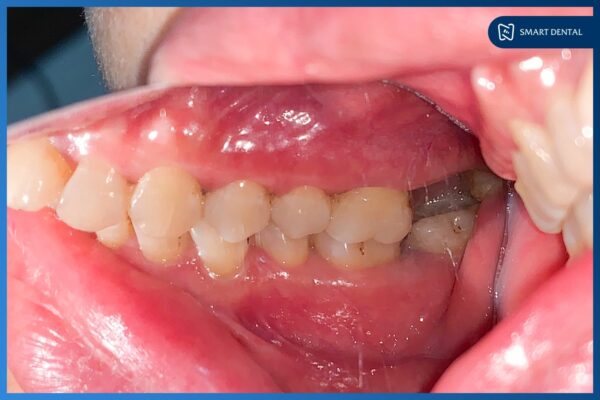 Cấy ghép Implant Hiossen Mỹ cho cô Nguyễn Thị Trà - Nha khoa Smart 2 Cấy ghép Implant Hiossen Mỹ cho cô Nguyễn Thị Trà - Nha khoa Smart 2