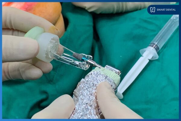 Cấy ghép Implant Hiossen Mỹ cho cô Nguyễn Thị Trà - Nha khoa Smart 3