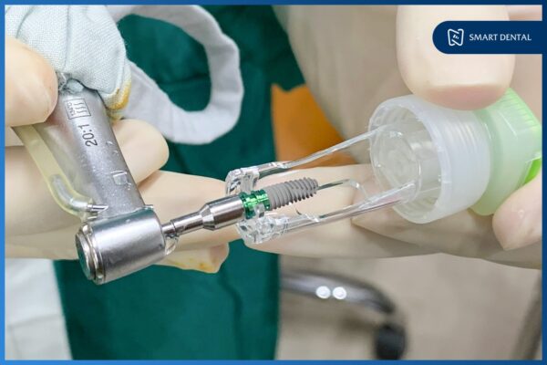 Trồng răng Implant bị sưng có sao không? - 5 cách giảm sưng hiệu quả 9 Trồng răng Implant bị sưng có sao không? - 5 cách giảm sưng hiệu quả 9