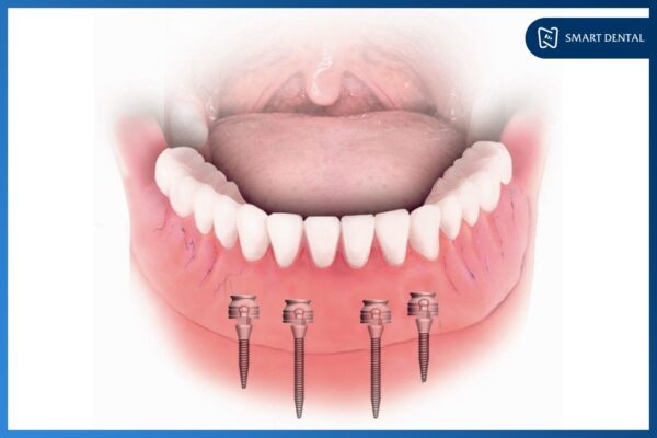 Cấy ghép mini Implant 3 Cấy ghép mini Implant 3