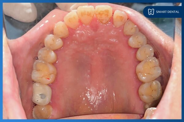 Khách hàng Bỉnh Thị Thanh trồng 1 răng Implant tại Nha khoa Smart 4 Khách hàng Bỉnh Thị Thanh trồng 1 răng Implant tại Nha khoa Smart 4