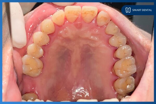 Khách hàng Bỉnh Thị Thanh trồng 1 răng Implant tại Nha khoa Smart 1 Khách hàng Bỉnh Thị Thanh trồng 1 răng Implant tại Nha khoa Smart 1
