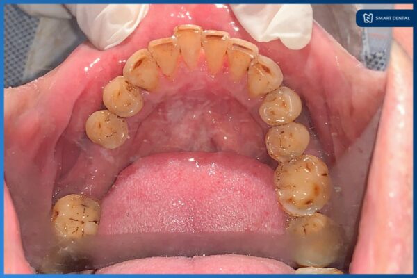 Khách hàng Cao Bằng Tường cấy ghép 2 răng Implant Osstem Hàn Quốc 2 Khách hàng Cao Bằng Tường cấy ghép 2 răng Implant Osstem Hàn Quốc 2