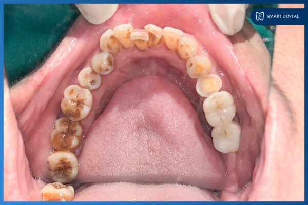 Cô Nguyễn Thị Thăng cấy ghép 3 trụ Implant Osstem Hàn Quốc 7 Cô Nguyễn Thị Thăng cấy ghép 3 trụ Implant Osstem Hàn Quốc 7