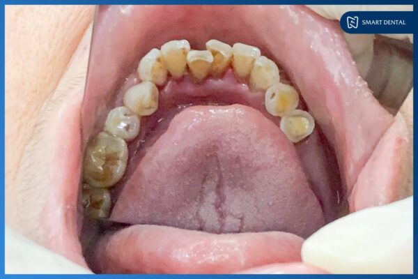 Cô Nguyễn Thị Thăng cấy ghép 3 trụ Implant Osstem Hàn Quốc 1