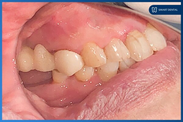 Cô Nguyễn Thị Thăng cấy ghép 3 trụ Implant Osstem Hàn Quốc 2 Cô Nguyễn Thị Thăng cấy ghép 3 trụ Implant Osstem Hàn Quốc 2