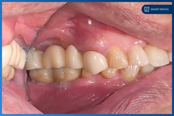 Cô Nguyễn Thị Thăng cấy ghép 3 trụ Implant Osstem Hàn Quốc 6