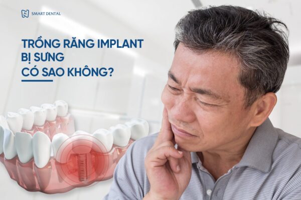 Trồng răng Implant bị sưng có sao không? - 5 cách giảm sưng hiệu quả 3 Trồng răng Implant bị sưng có sao không? - 5 cách giảm sưng hiệu quả 3