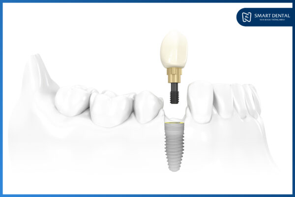 Răng Implant bị lung lay phải làm sao? Cách khắc phục nào hiệu quả? 2 Răng Implant bị lung lay phải làm sao? Cách khắc phục nào hiệu quả? 2