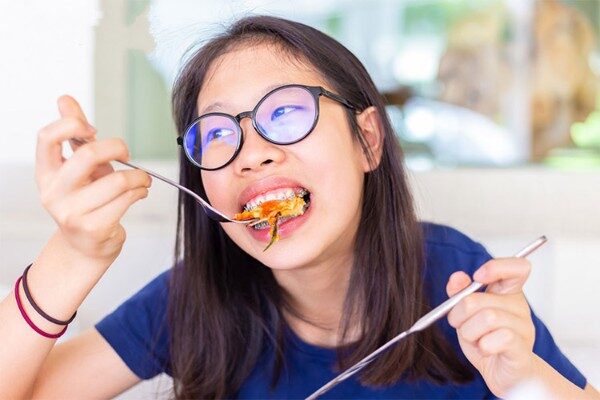 Răng hơi hô có nên niềng 2 Răng hơi hô có nên niềng 2